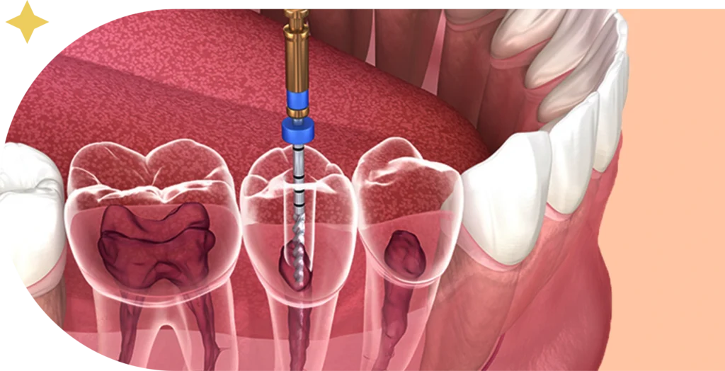 A detailed medical illustration of a root canal procedure being performed on a molar tooth. A dental file instrument is shown inside the tooth's root chamber, removing the pulp. The surrounding gum, jawbone, and other teeth are visible.